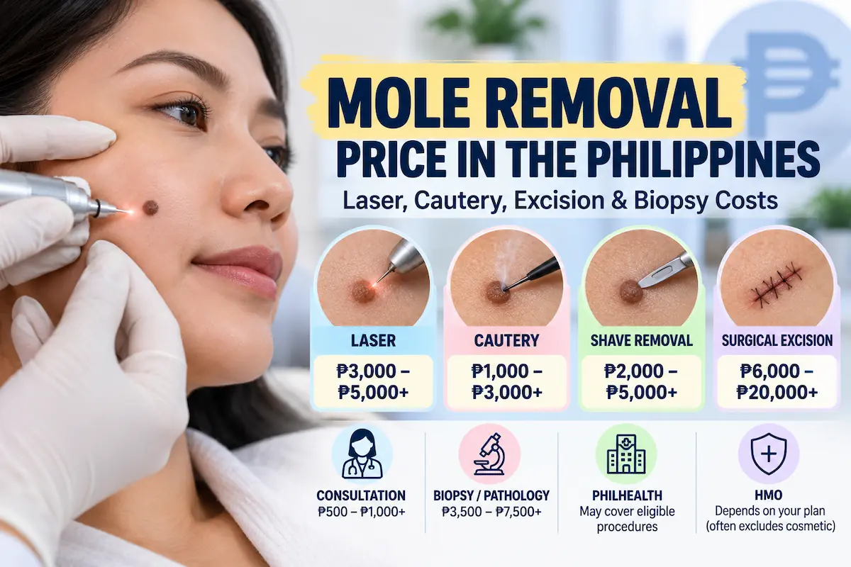 Mole removal price in the Philippines showing laser, cautery, shave removal, surgical excision and biopsy cost ranges